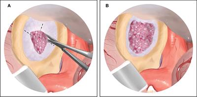 Endoscopic transcranial transdiaphragmatic approach in a single-stage surgery for giant pituitary adenomas